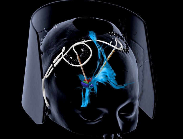 Studie zur tiefen Hirnstimulation