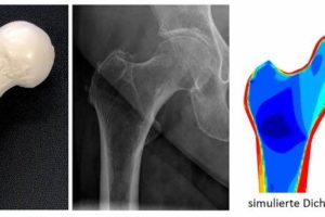 Individuelle Osteoporose-Therapie mit FEM