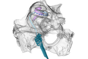 Cochlea Implantat uni göttingen uni freiburg