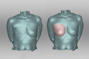 3D-Scanner hilft bei der Erstellung passgenauer Brustprothesen
