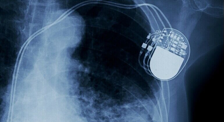 x-ray_image_of_permanent_pacemaker_implant_in_chest_body_,_process_in_blue_tone