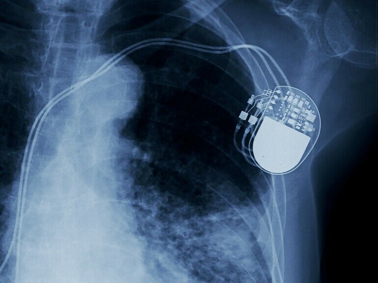 Cybersicherheit bei Herzschrittmachern: Besser aufklären