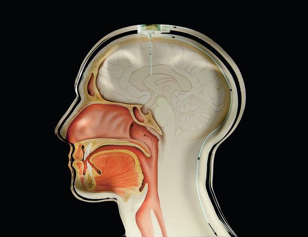 Implantat überwacht den Druck im Gehirn