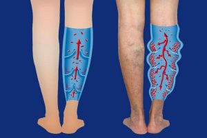 Varicose_veins_on_a_female_senior_legs._The_structure_of_normal_and_varicose_veins._Concept_of_dry_skin,_old_senior_people,_varicose_veins_and_deep_vein_thrombosis_or_DVT