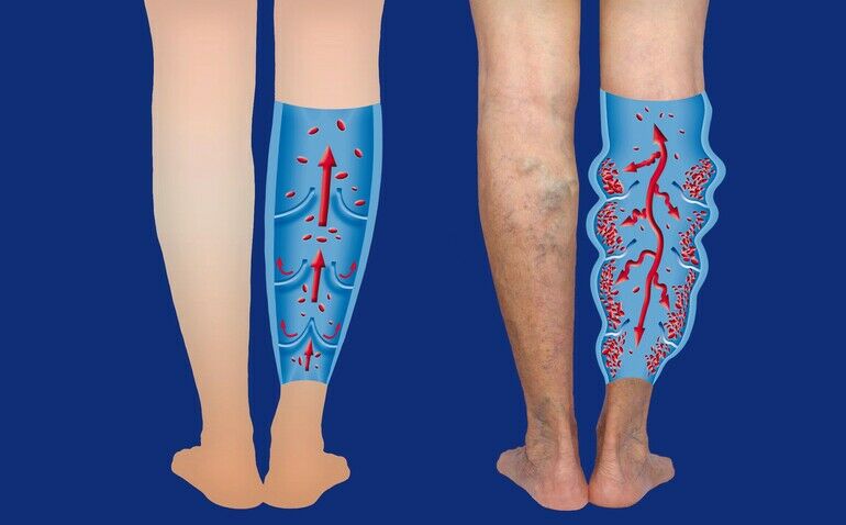 Varicose_veins_on_a_female_senior_legs._The_structure_of_normal_and_varicose_veins._Concept_of_dry_skin,_old_senior_people,_varicose_veins_and_deep_vein_thrombosis_or_DVT