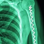 X-ray_image_of_shoulder
