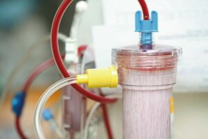 Was ist Dialyse: Lebensrettendes Filtersystem