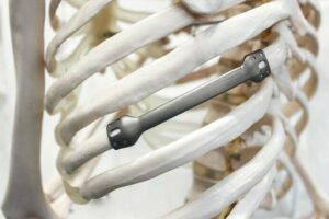 Implantate aus amorphem Metall: Rippenersatz passend zum Patienten