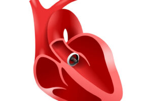 Biologische Beschichtung verbessert Herzklappe