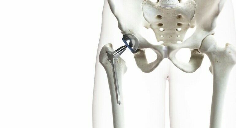 3d_rendered_medically_accurate_illustration_of_a_hip_replacement