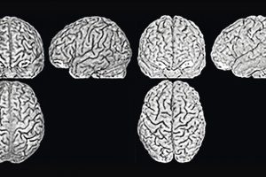 Gehirnanatomie ist so einzigartig wie ein Fingerabdruck