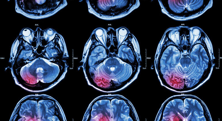 Film_MRI_(_Magnetic_resonance_imaging_)_of_brain_(_stroke_,_brain_tumor_,_cerebral_infarction_,_intracerebral_hemorrhage_)__(_Medical_,_Health_care_,_Science_Background_)_(_Cross_section_of_brain_)