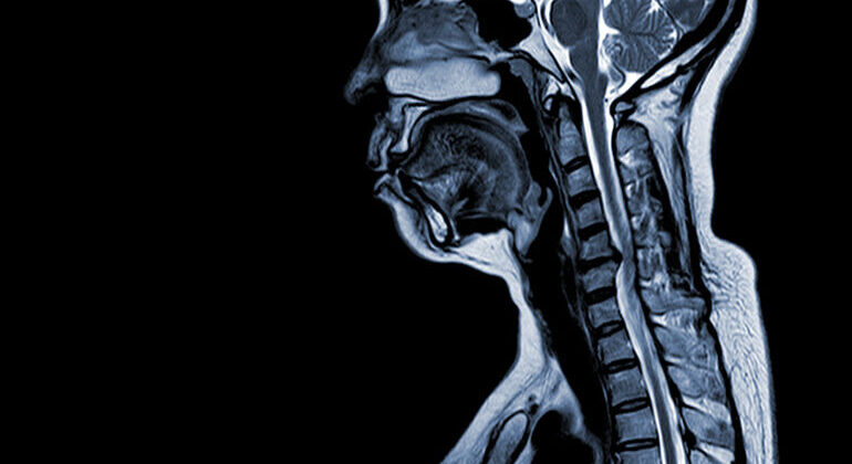 MRI_(1.5_tesla)_of_the_cervical_spine_was_performed_by_sagittal_T1W_Moderate_spinal_cord_compression_at_C5-6_(6_mm_in_AP)_with_myelopathy_.