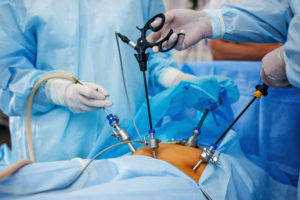 Operation_using_laparoscopic_equipment