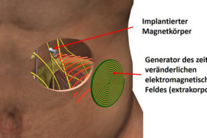 Magnetoceuticals für Elektrostimulation ohne Kabel