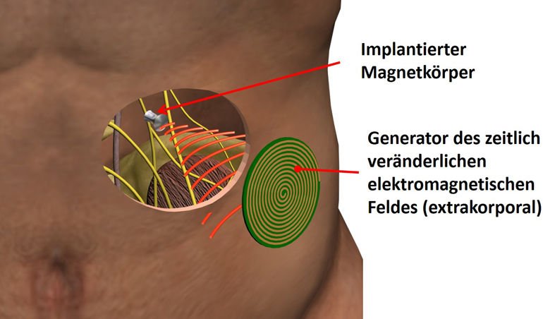 Magnetoceuticals für Elektrostimulation ohne Kabel